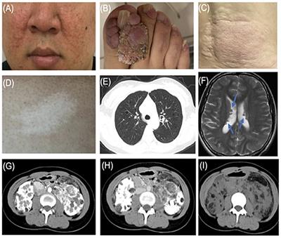 Analysis of Clinical Features and Next-Generation Sequencing of 12 Tuberous Sclerosis Families in China